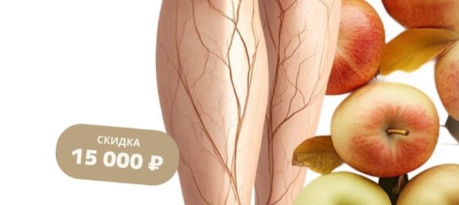 Скидка 15 000 рублей на лечение варикоза !