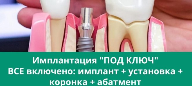 Имплантация «ПОД КЛЮЧ»