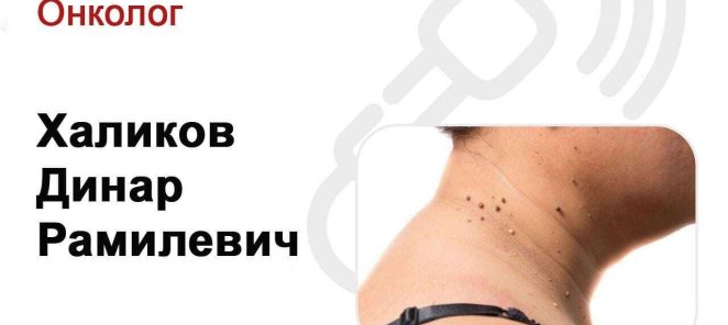 Удаление доброкачественных новообразований