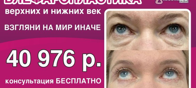 🟢 БЛЕФАРОПЛАСТИКА ВЕРХНИХ И НИЖНИХ ВЕК. Предварительная кон