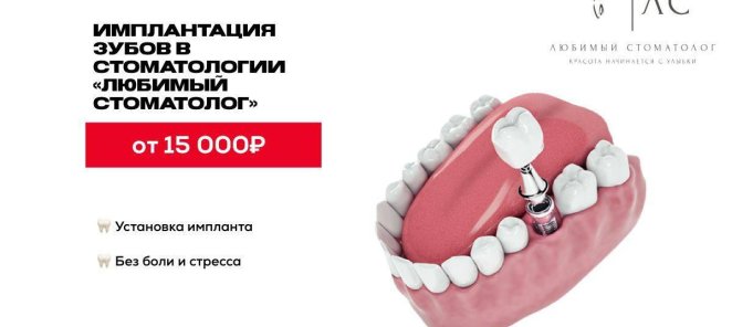 Имплантация зубов от 15000₽