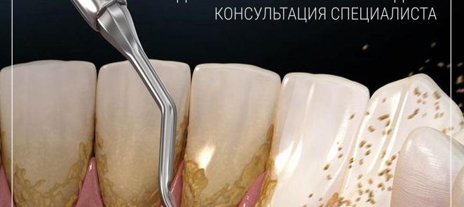 Профессиональная гигиена полости рта за пол цены!