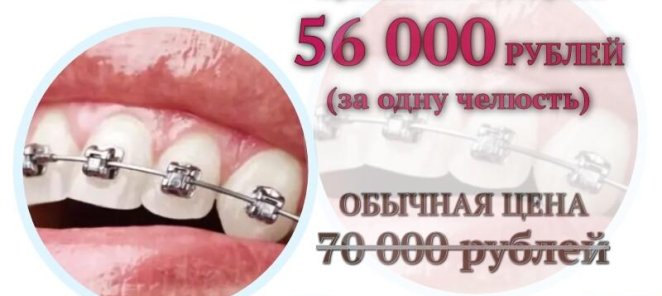 Установка безлигатурных брекетов со скидкой