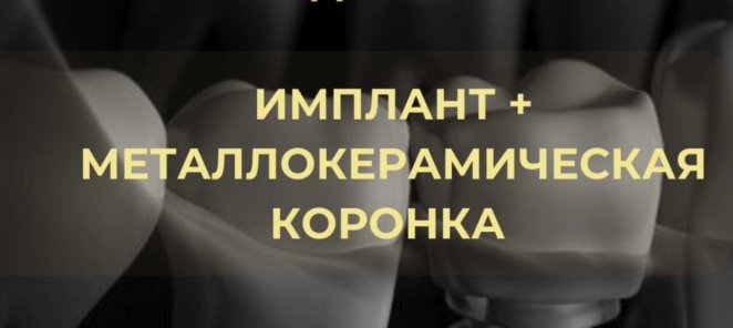Имплантация под ключ 49.900 рублей