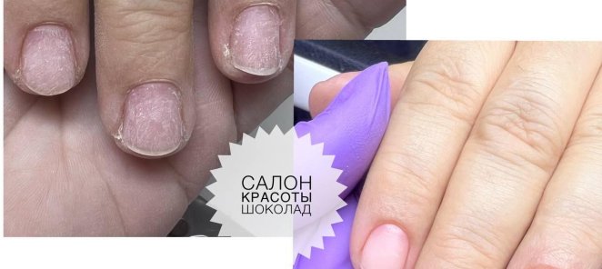 Новая процедура мультиплазма - мгновенное восстановление ног