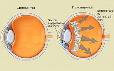 Лечение глаукомы