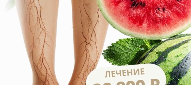 Комплексное лазерное лечение ВАРИКОЗА за один день всего 299
