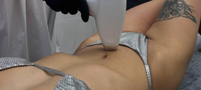 Акция сентября: лазерная эпиляция для новых