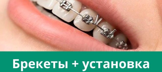 Брекеты + установка 35000 руб.🔥
