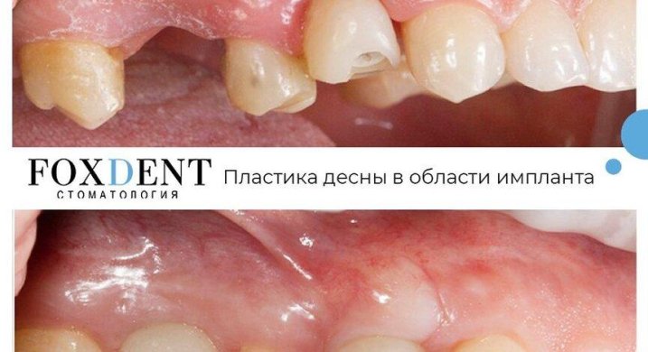 Удаление зуба Томск Профсоюзная Импланты ИМПРО (IMPRO) Томск Омская