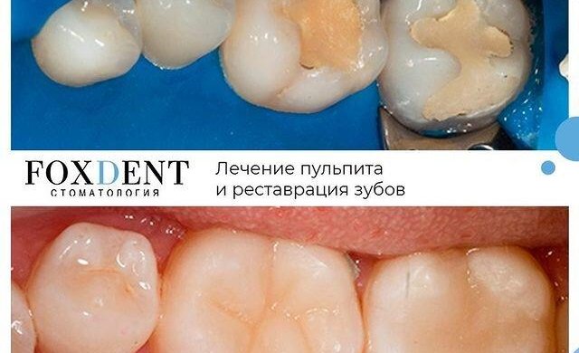 удаление зуба Томск Профсоюзная