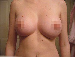 Асимметричная грудь и пластическая операция