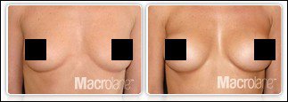 Макролайн — увеличение груди без операции