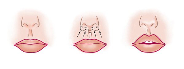 Операция булхорн или как увеличить губы без инъекций