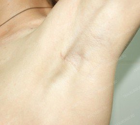 Frau Klinik: Увеличение груди без следа от операции