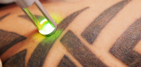 Новый лазер не оставляет рубцов после удаления тату