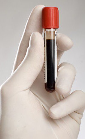 Какой анализ крови показывает онкологию