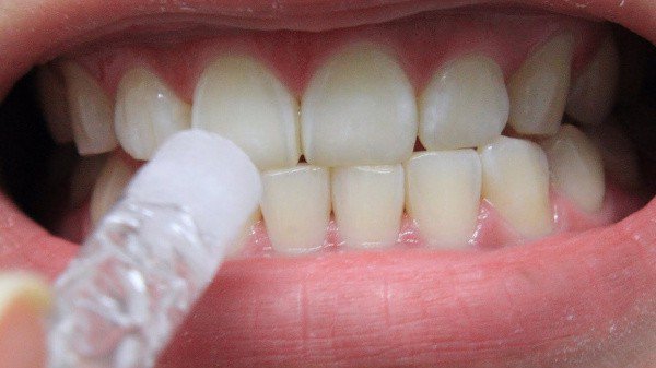 15 советов, как отбелить зубы в домашних условиях