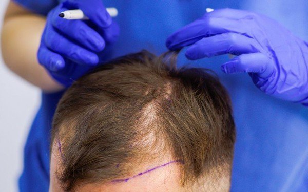 Подарки при трансплантации волос в клинике HFE