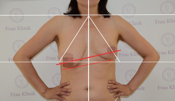 Асимметрия груди: стоит ли корректировать?