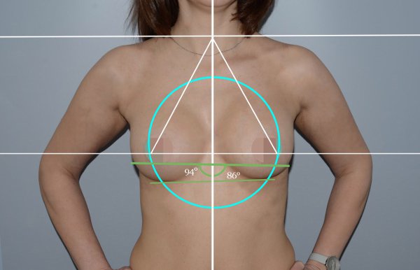 Асимметрия груди: стоит ли корректировать?