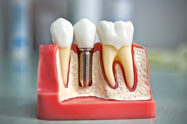 Зубные импланты или протезы?