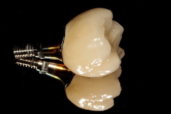 Все тайны зубных имплантатов