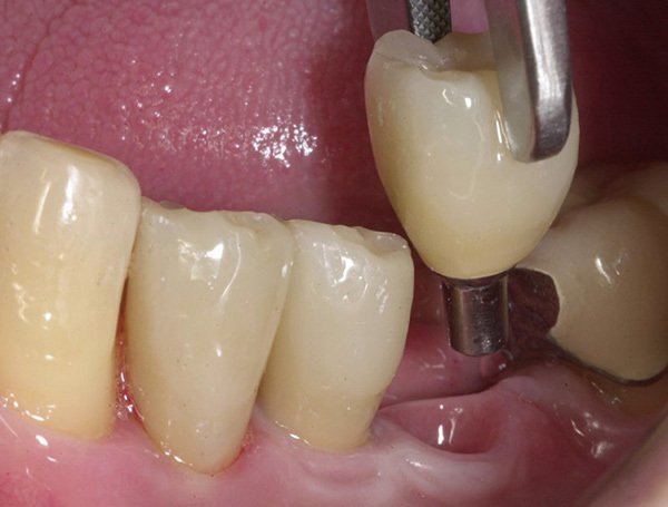 Все тайны зубных имплантатов