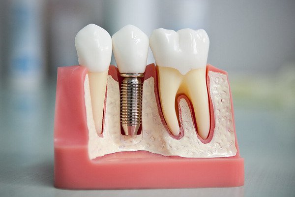 Ученые обнадеживают: необходимость в зубных имплантах скоро отпадет