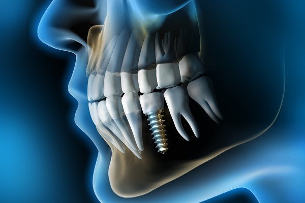 6 неочевидных фактов об имплантации зубов