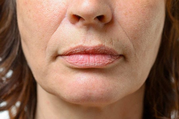 Почему возникают и как устранить морщины вокруг рта?