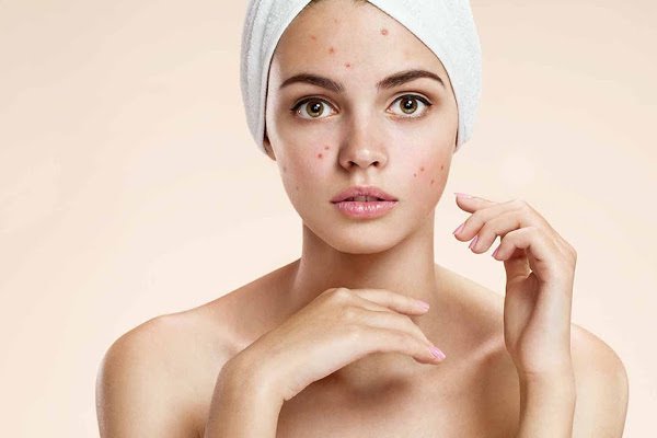 Акне и макияж: правила нанесения косметики, чтобы не навредить коже