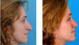 Восстановление носа после травм