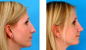Восстановление носа после травм