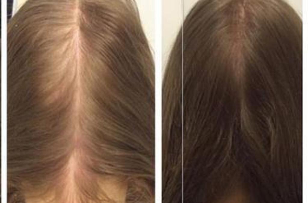 Результаты роста волос. Сатура роста. Сатура роста фото до и после. Ага у женщин фото.