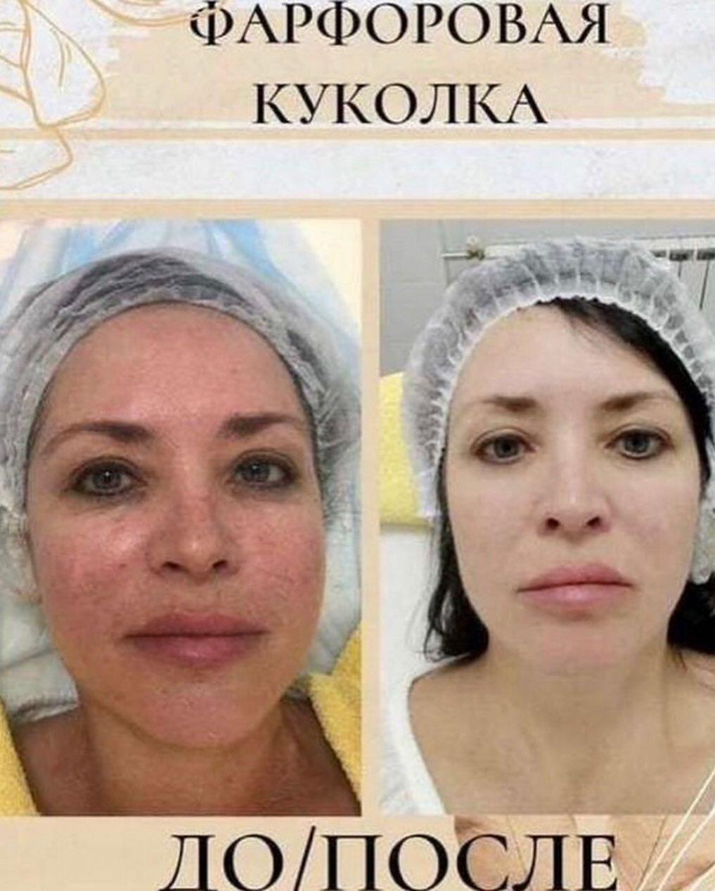 Фарфоровая кукла процедура для лица до и после
