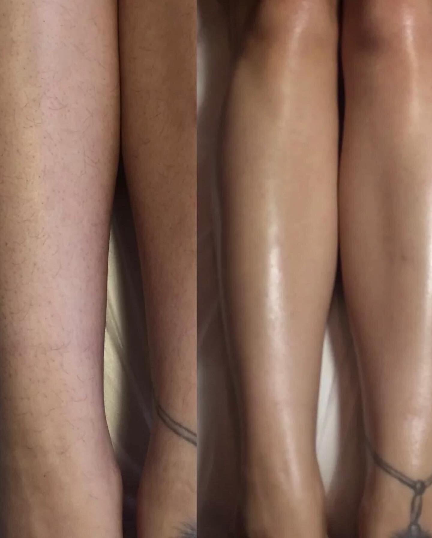 Депиляция ног фото до и после
