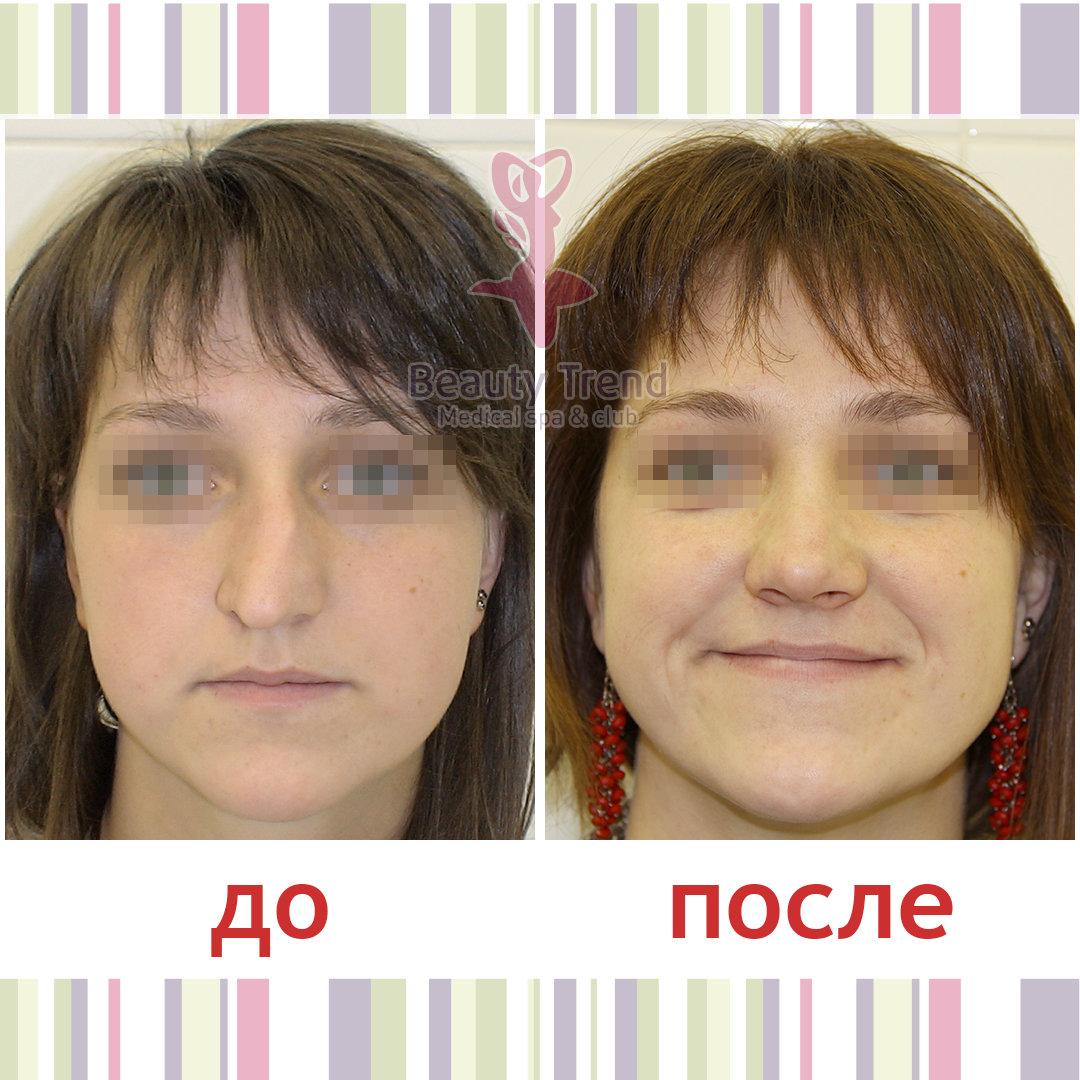 Операция носовой перегородки по омс. Кашманов ринопластика. Септопластика до и после фото.