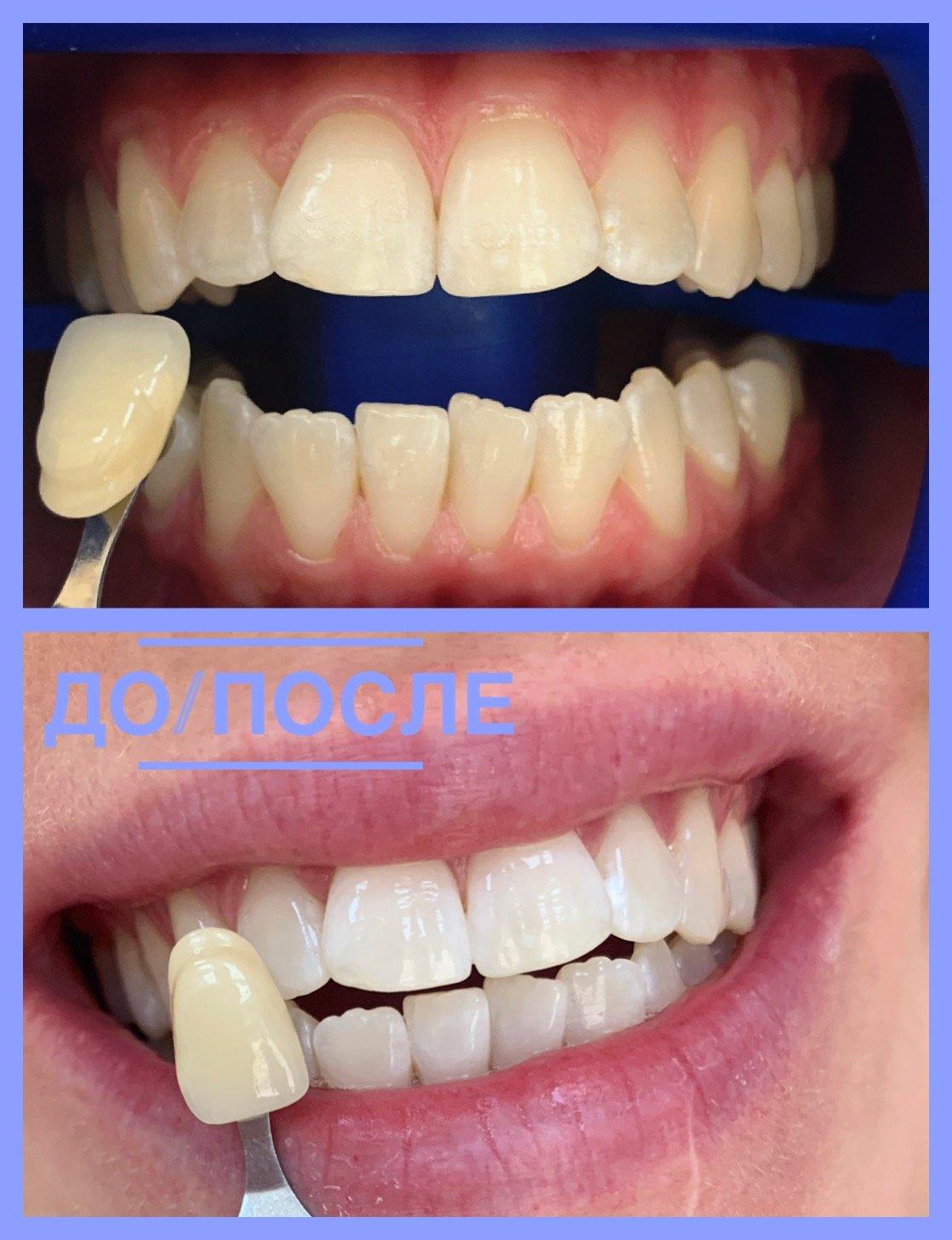Фотоотбеливание зубов Томск Маяковского томск стоматология улыбка отзывы