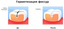 Недорогое лечение пульпита в Новокузнецке